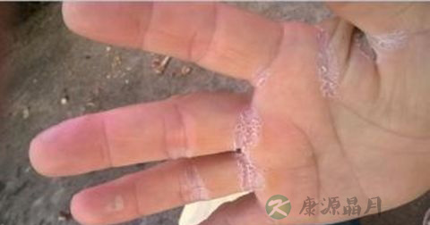 真菌感染是由什么引起的 真菌感染是由什么引起的