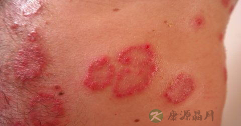 紫癜性肾病如何区分 紫癜性肾病如何区分