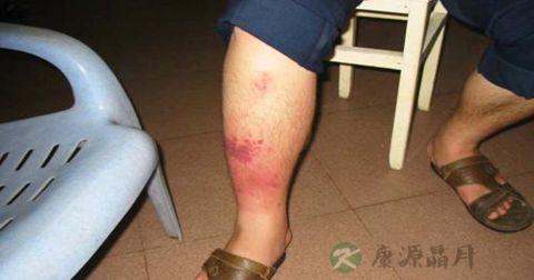 丹毒丝菌属有哪几种菌 丹毒丝菌属有哪几种菌