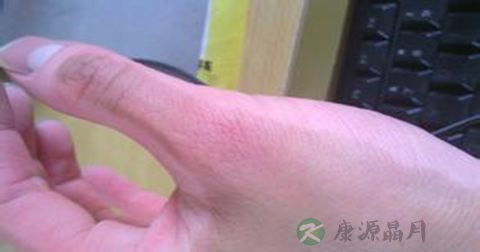 真菌感染用什么药 真菌感染用什么药