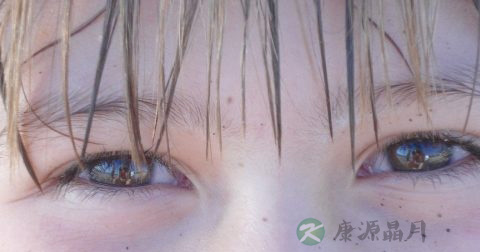 激光治疗近视价格表 激光治疗近视价格表