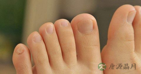 糖尿病足水泡怎么护理 糖尿病足水泡怎么护理