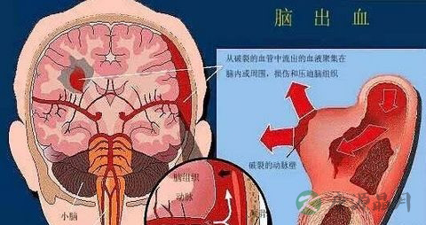 脑出血人的症状 脑出血人的症状