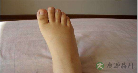 糖尿病浮肿是尿毒症吗 糖尿病浮肿是尿毒症吗