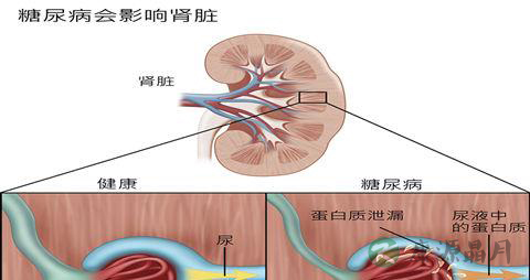 糖尿病肾病怎么治 糖尿病肾病怎么治