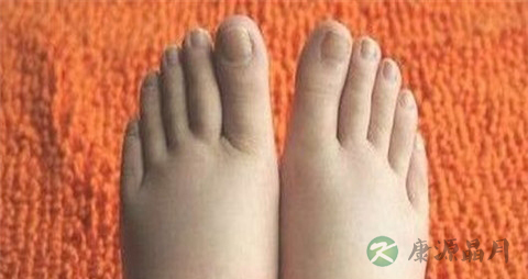 糖尿病浮肿是尿毒症吗 糖尿病浮肿是尿毒症吗