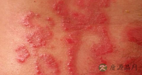 糖尿病皮肤瘙痒起风团怎么办 糖尿病皮肤瘙痒起风团怎么办