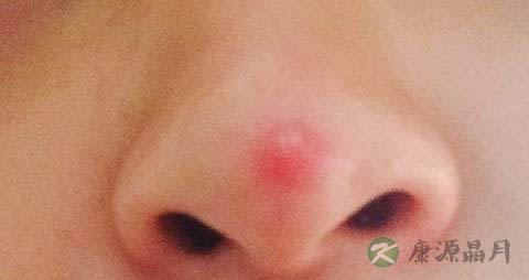 老年人药物性肝病怎么吃 老年人药物性肝病怎么吃