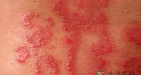 银屑病的原因 银屑病的原因