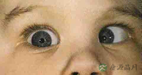 斜视的原因 斜视的原因