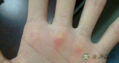 角质化是什么原因 角质化是什么原因