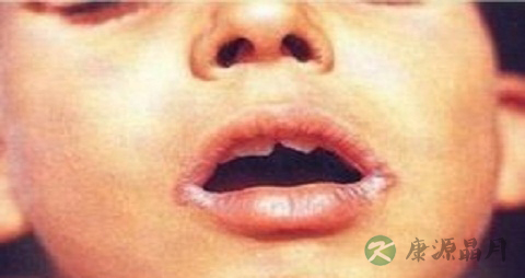 口角生疮是什么原因 口角生疮是什么原因