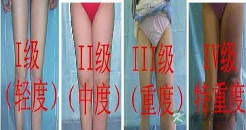 淋巴水肿的原因 淋巴水肿的原因
