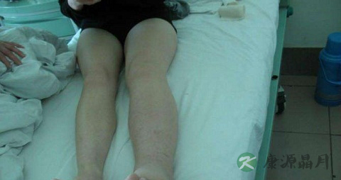 淋巴水肿的原因 淋巴水肿的原因