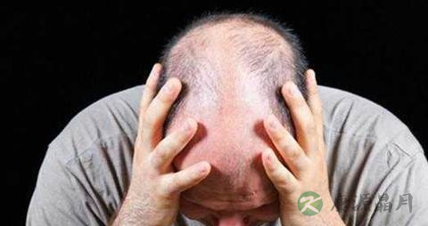秃头的症状 秃头的症状