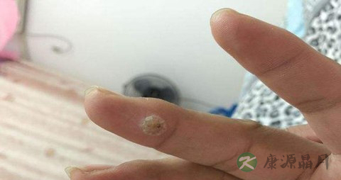 疣的症状 疣的症状