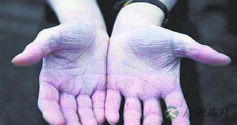 水俣病的症状 水俣病的症状