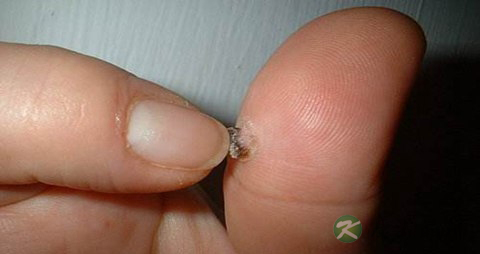疣的症状 疣的症状