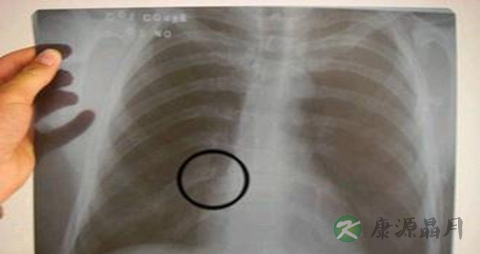 肋骨骨折的症状 肋骨骨折的症状