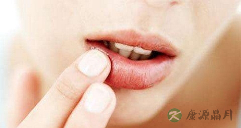 口角炎的症状 口角炎的症状