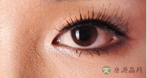 干眼症的症状 干眼症的症状