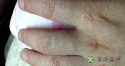 红斑狼疮吃什么药 红斑狼疮吃什么药