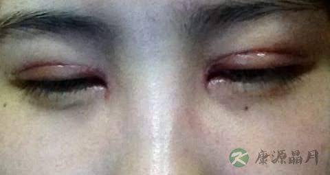 疤痕增生吃什么药 疤痕增生吃什么药