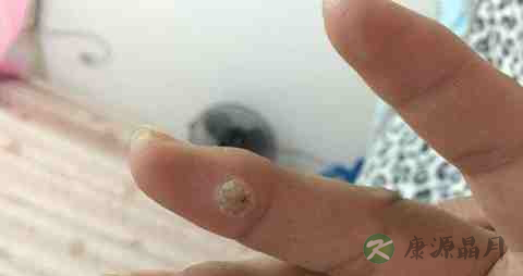 疣吃什么药 疣吃什么药