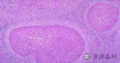 原发性腹膜炎吃什么药 原发性腹膜炎吃什么药