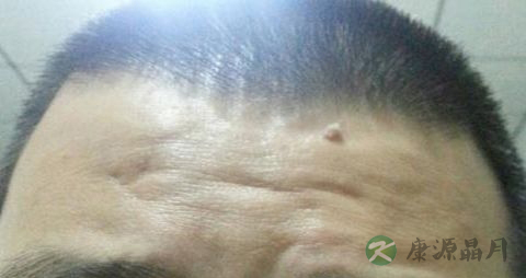 息肉吃什么药 息肉吃什么药