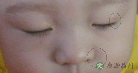 疤痕增生吃什么药 疤痕增生吃什么药