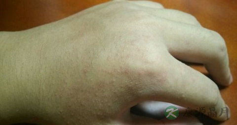 痱子吃什么药 痱子吃什么药