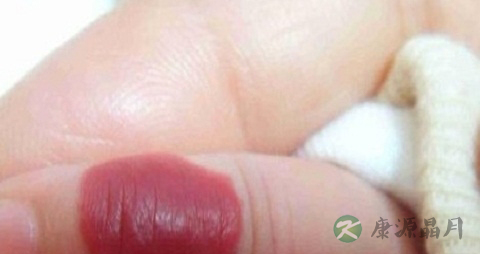 毛细血管瘤不能吃什么,毛细血管瘤的注意事项 毛细血管瘤不能吃什么,毛细血管瘤的注意事项