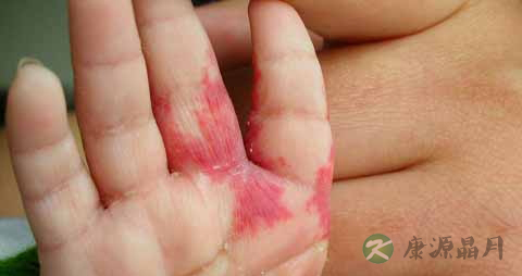 毛细血管瘤不能吃什么,毛细血管瘤的注意事项 毛细血管瘤不能吃什么,毛细血管瘤的注意事项