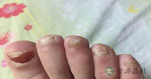 甲癣不能吃什么,甲癣的注意事项 甲癣不能吃什么,甲癣的注意事项