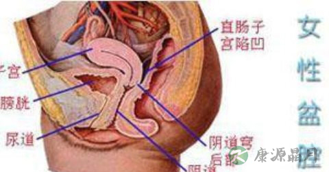 盆腔积液多如何排除 盆腔积液多如何排除