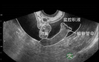 盆腔积液多如何排除 盆腔积液多如何排除