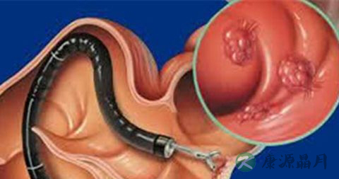 宫颈息肉术后多久可以怀孕 宫颈息肉术后多久可以怀孕