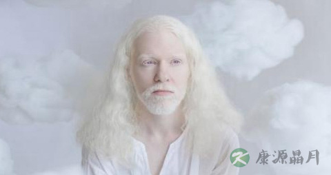 白化病人最多能活多久 白化病人最多能活多久