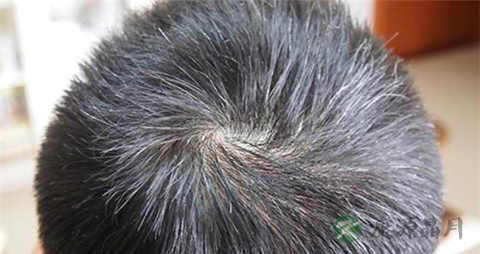 得了白血病掉头发吗 得了白血病掉头发吗