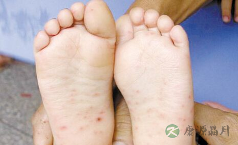 手足口病摸过东西会传染吗 手足口病摸过东西会传染吗