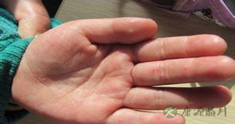 如何鉴别麻疹水痘和手足口病 如何鉴别麻疹水痘和手足口病