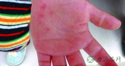 重度手足口病有后遗症吗 重度手足口病有后遗症吗
