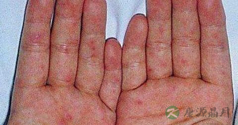 手足口病发热怎么治疗 手足口病发热怎么治疗