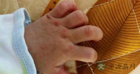手足口病会二次被传染吗 手足口病会二次被传染吗