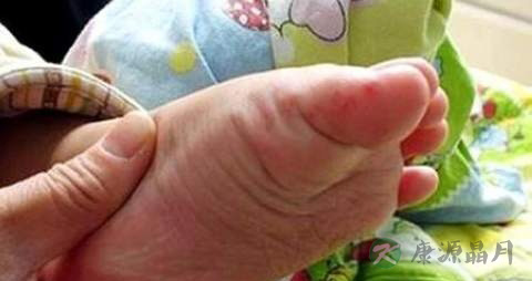 手足口病病后怎么护理 手足口病病后怎么护理