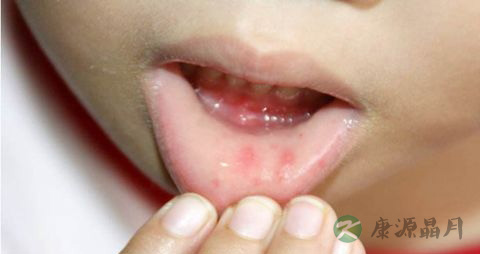 幼儿手足口病的护理 幼儿手足口病的护理