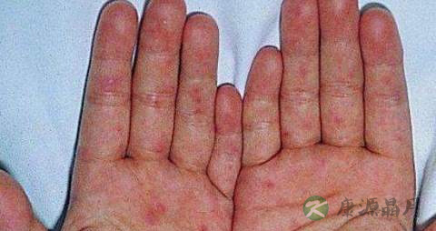手足口病病后怎么护理 手足口病病后怎么护理