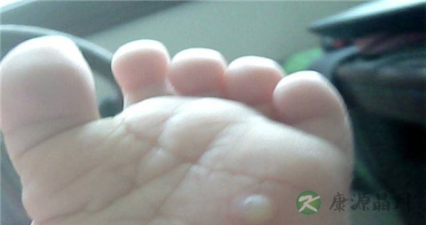 手足口病能吃益生菌吗 手足口病能吃益生菌吗