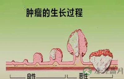 肿瘤是动的好还是不动的好 肿瘤是动的好还是不动的好
